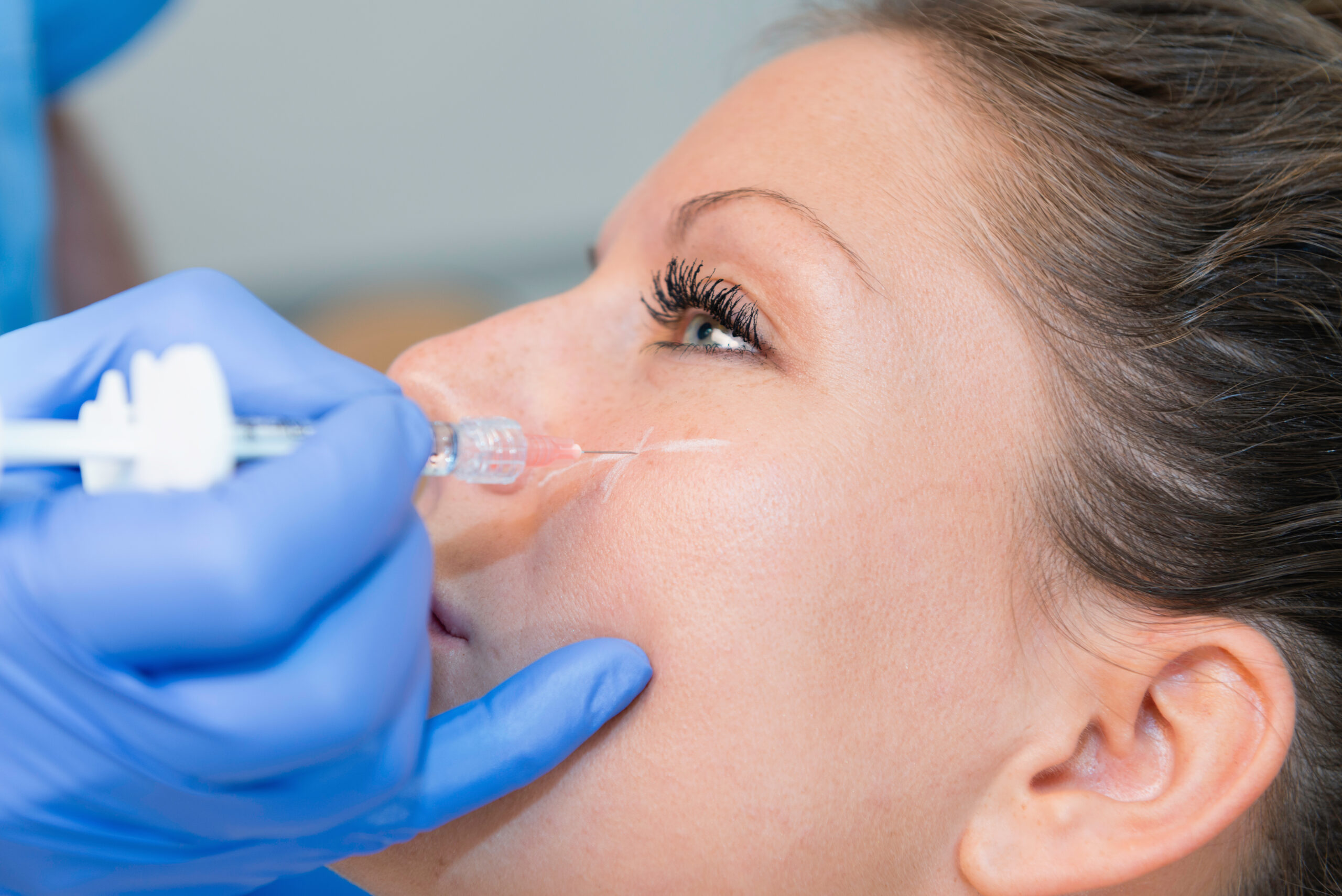Hyaluronic acid treatment